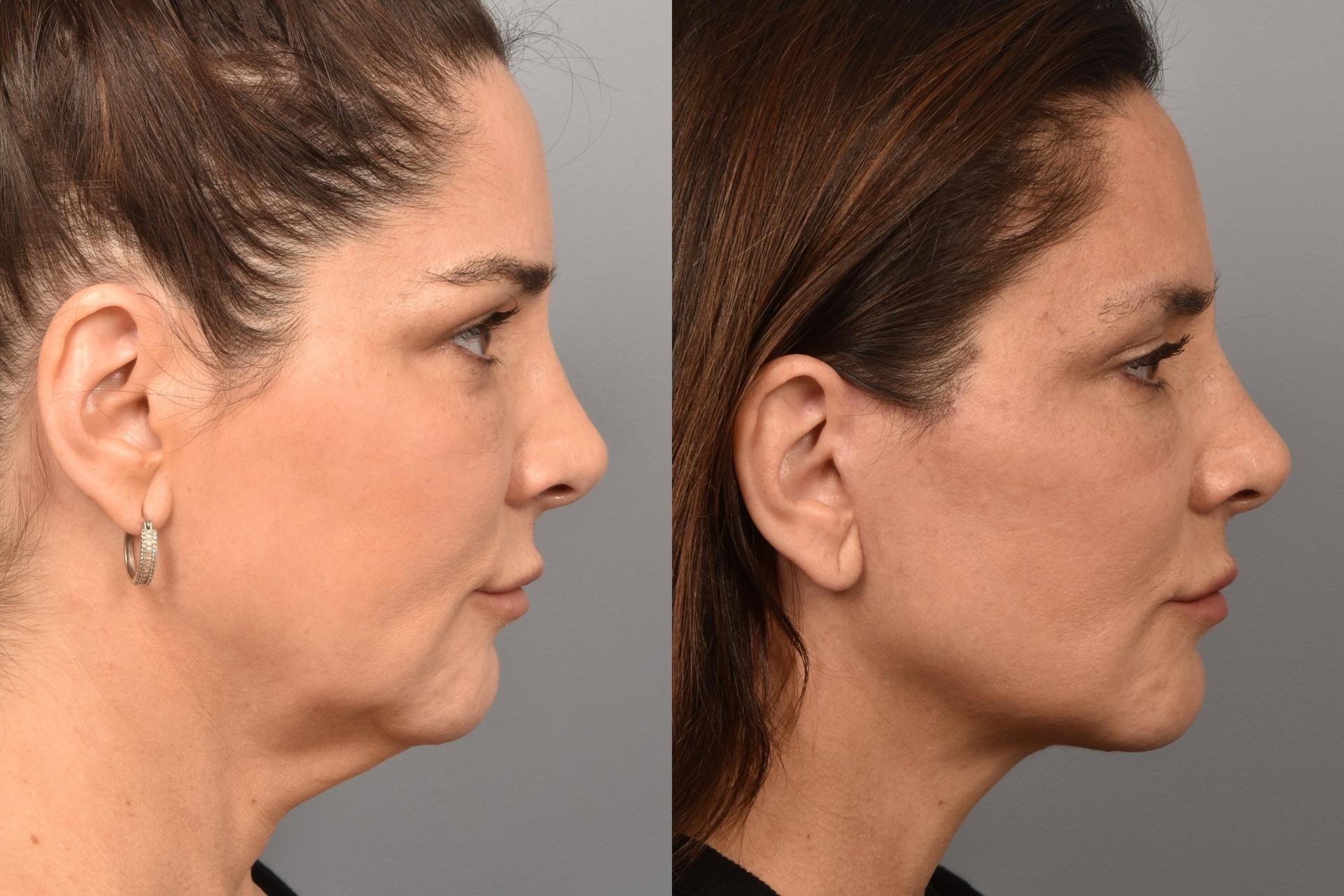 Meryam Shikara, MD facelift result — New York, NY