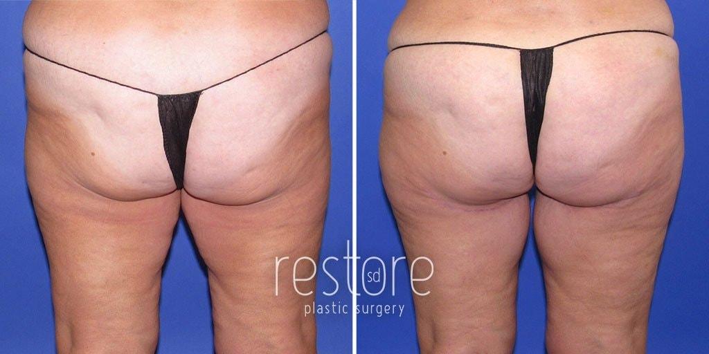 Restore SD Plastic Surgery: Katerina Gallus, MD, FACS thigh lift result — San Diego, CA