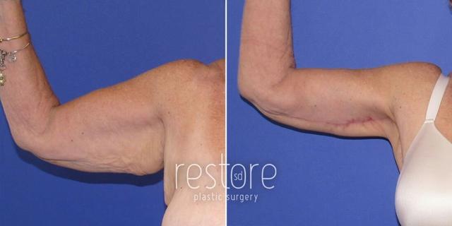 Arm Lift result at Restore SD Plastic Surgery: Katerina Gallus, MD, FACS in San Diego, CA
