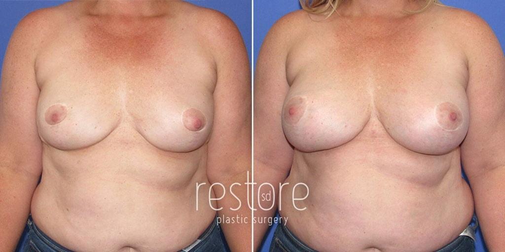Restore SD Plastic Surgery: Katerina Gallus, MD, FACS breast augmentation result — San Diego, CA