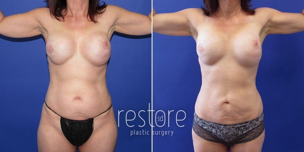 Restore SD Plastic Surgery: Katerina Gallus, MD, FACS breast fat transfer result — San Diego, CA