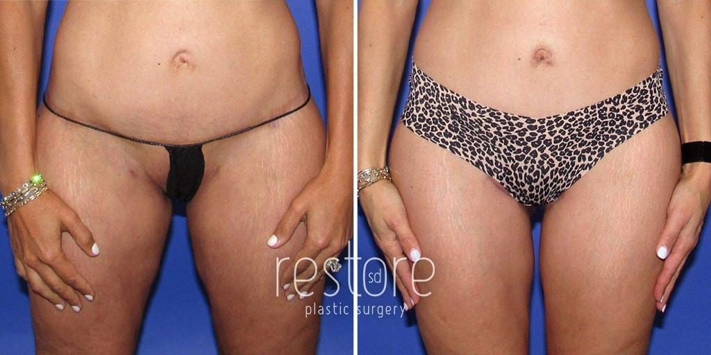 Restore SD Plastic Surgery: Katerina Gallus, MD, FACS thigh lift result — San Diego, CA