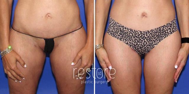 Thigh Lift result at Restore SD Plastic Surgery: Katerina Gallus, MD, FACS in San Diego, CA