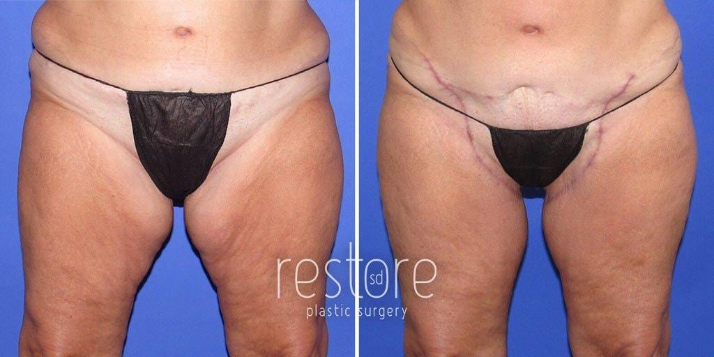 Restore SD Plastic Surgery: Katerina Gallus, MD, FACS thigh lift result — San Diego, CA