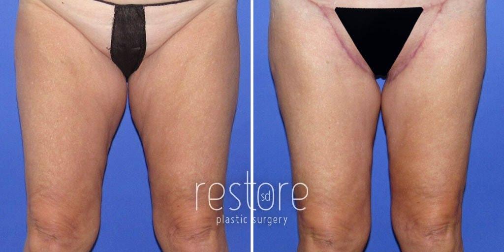 Restore SD Plastic Surgery: Katerina Gallus, MD, FACS thigh lift result — San Diego, CA