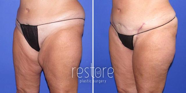 Thigh Lift result at Restore SD Plastic Surgery: Katerina Gallus, MD, FACS in San Diego, CA