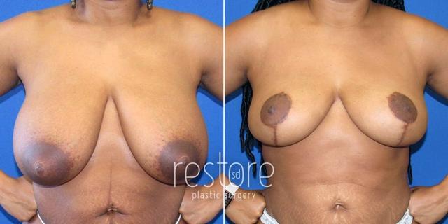 Breast Reduction result at Restore SD Plastic Surgery: Katerina Gallus, MD, FACS in San Diego, CA