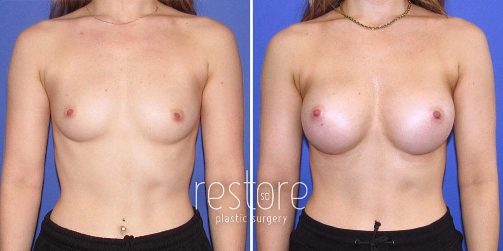 Restore SD Plastic Surgery: Katerina Gallus, MD, FACS breast augmentation result — San Diego, CA