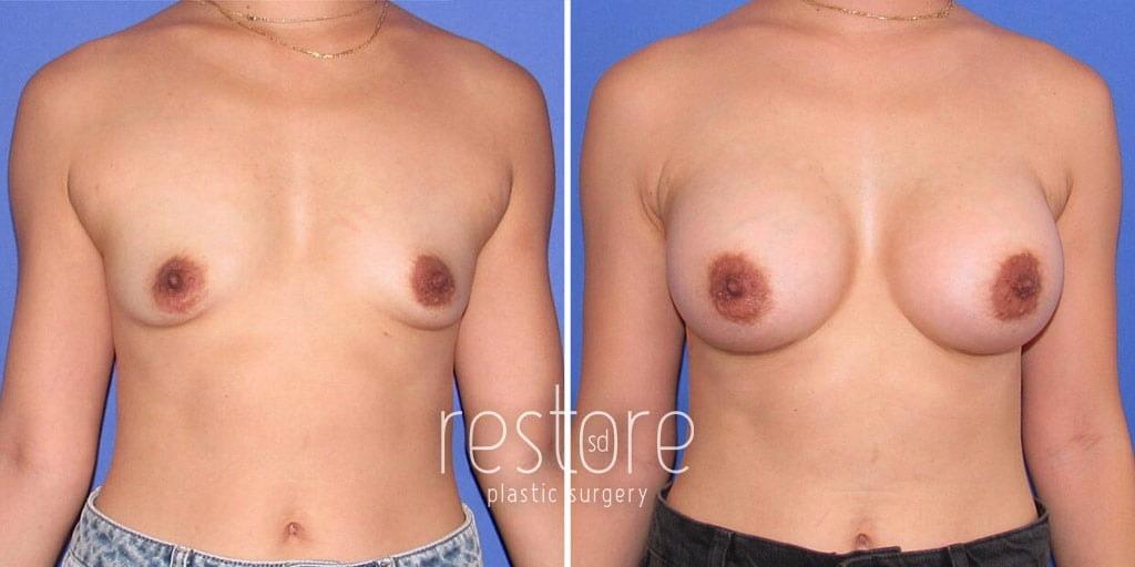 Restore SD Plastic Surgery: Katerina Gallus, MD, FACS breast augmentation result — San Diego, CA