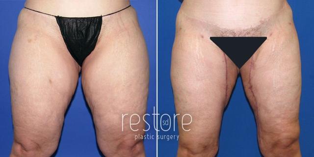 Thigh Lift result at Restore SD Plastic Surgery: Katerina Gallus, MD, FACS in San Diego, CA