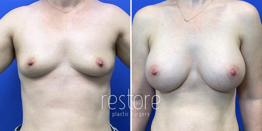 Restore SD Plastic Surgery: Katerina Gallus, MD, FACS breast augmentation result — San Diego, CA