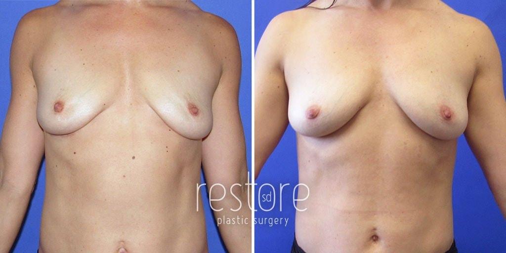 Restore SD Plastic Surgery: Katerina Gallus, MD, FACS breast fat transfer result — San Diego, CA