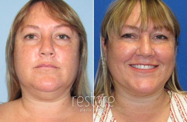Neck Liposuction result at Restore SD Plastic Surgery: Katerina Gallus, MD, FACS in San Diego, CA