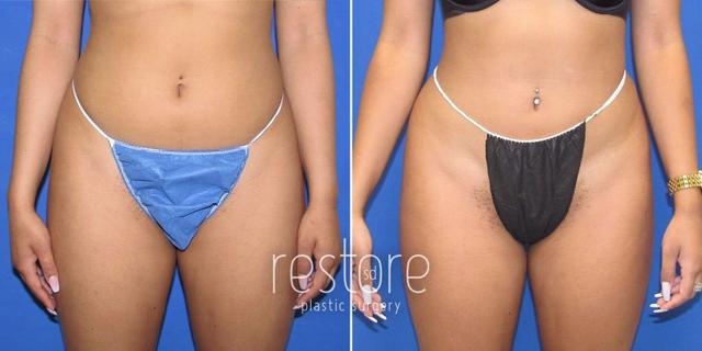 Brazilian Butt Lift result at Restore SD Plastic Surgery: Katerina Gallus, MD, FACS in San Diego, CA