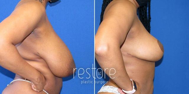 Breast Reduction result at Restore SD Plastic Surgery: Katerina Gallus, MD, FACS in San Diego, CA