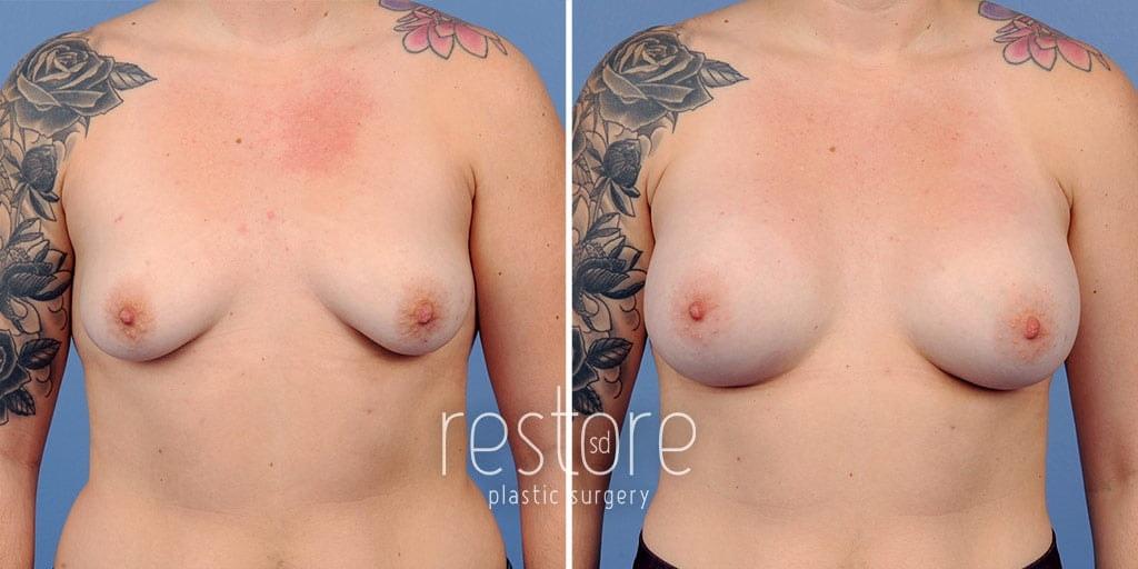 Restore SD Plastic Surgery: Katerina Gallus, MD, FACS breast augmentation result — San Diego, CA