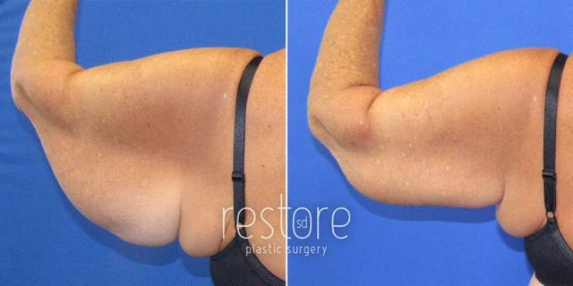 Arm Lift result at Restore SD Plastic Surgery: Katerina Gallus, MD, FACS in San Diego, CA