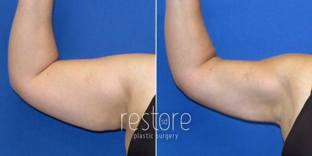 Liposuction result at Restore SD Plastic Surgery: Katerina Gallus, MD, FACS in San Diego, CA