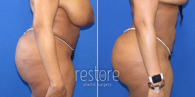 Brazilian Butt Lift result at Restore SD Plastic Surgery: Katerina Gallus, MD, FACS in San Diego, CA