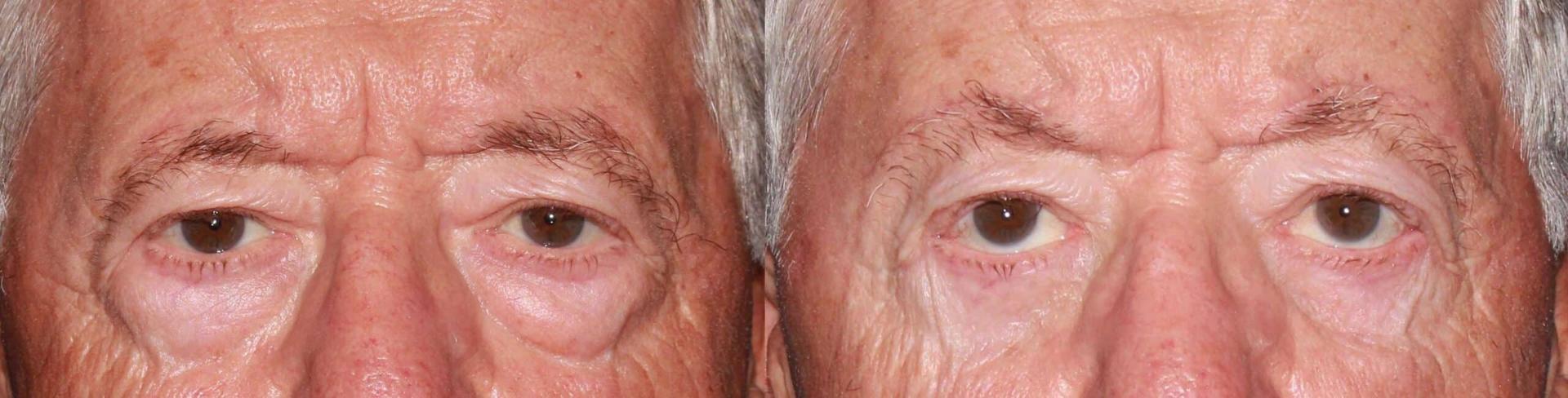 Anthony Aesthetics Facial Plastic Surgery (Charles Anthony II, MD) eyelid lift result — St. Petersburg, FL