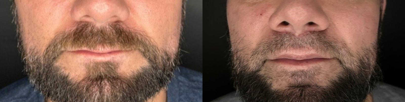 Anthony Aesthetics Facial Plastic Surgery (Charles Anthony II, MD) lip lift result — St. Petersburg, FL