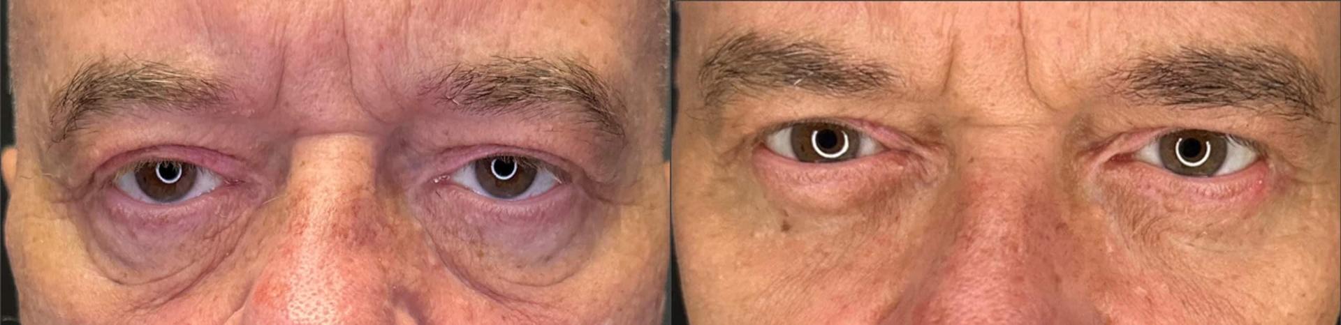 Anthony Aesthetics Facial Plastic Surgery (Charles Anthony II, MD) eyelid lift result — St. Petersburg, FL