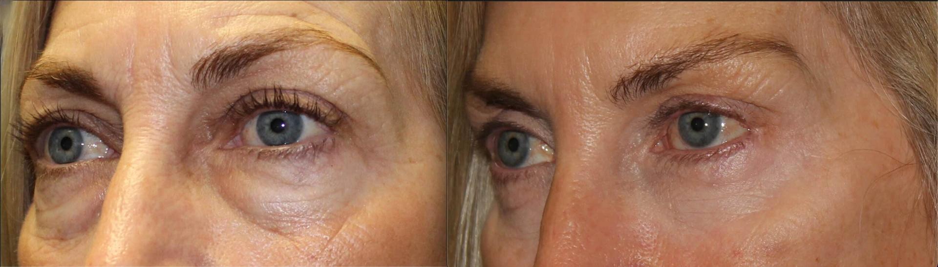 Anthony Aesthetics Facial Plastic Surgery (Charles Anthony II, MD) eyelid lift result — St. Petersburg, FL
