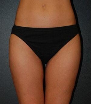 Steely Plastic Surgery liposuction after — Houston, TX