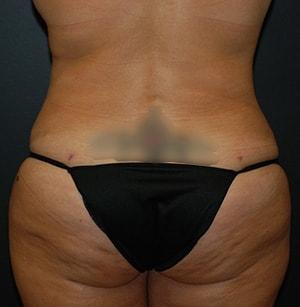 Steely Plastic Surgery liposuction after — Houston, TX