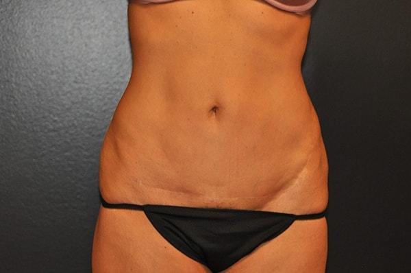 Steely Plastic Surgery tummy tuck after — Houston, TX
