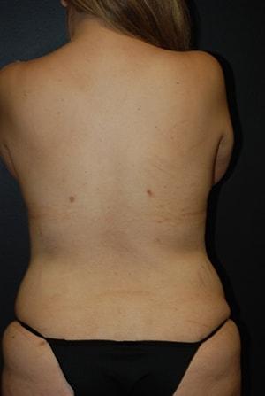 Steely Plastic Surgery liposuction after — Houston, TX