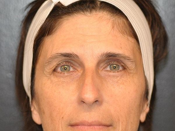 Brow Lift before at Steely Plastic Surgery in Houston, TX