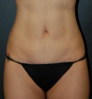 Steely Plastic Surgery tummy tuck after — Houston, TX