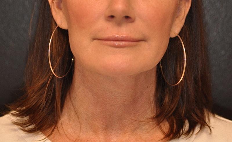 Steely Plastic Surgery facelift after — Houston, TX