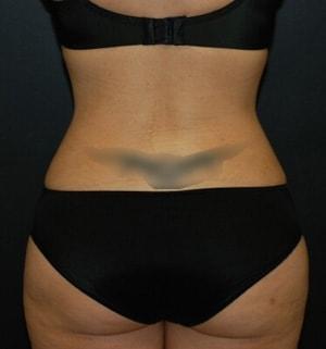 Steely Plastic Surgery liposuction after — Houston, TX