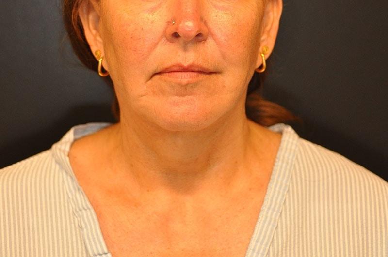Steely Plastic Surgery facelift after — Houston, TX
