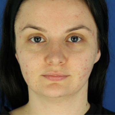 Laser Skin Resurfacing before at EvolvMD MedSpa & Wellness I Milwaukee, WI in Wauwatosa, WI