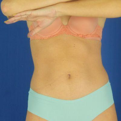 Liposuction after at EvolvMD MedSpa & Wellness I Milwaukee, WI in Wauwatosa, WI