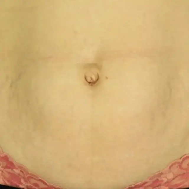 Morpheus8 after at EvolvMD MedSpa & Wellness I Milwaukee, WI in Wauwatosa, WI