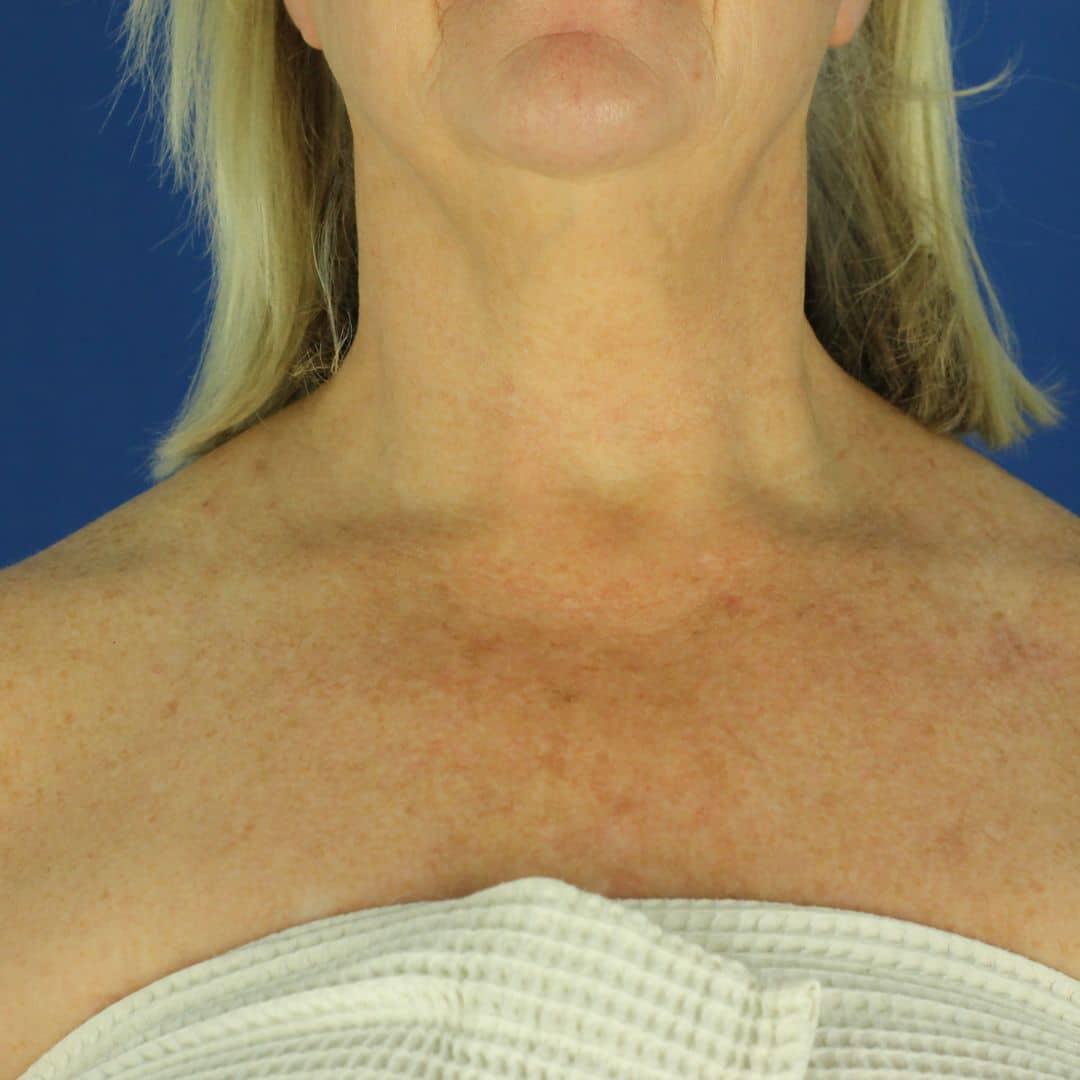 EvolvMD MedSpa & Wellness I Milwaukee, WI bbl after — Wauwatosa, WI