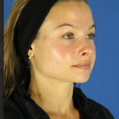 Laser Skin Resurfacing after at EvolvMD MedSpa & Wellness I Milwaukee, WI in Wauwatosa, WI