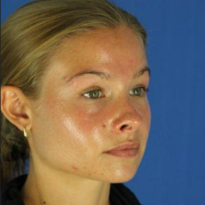 Laser Skin Resurfacing before at EvolvMD MedSpa & Wellness I Milwaukee, WI in Wauwatosa, WI