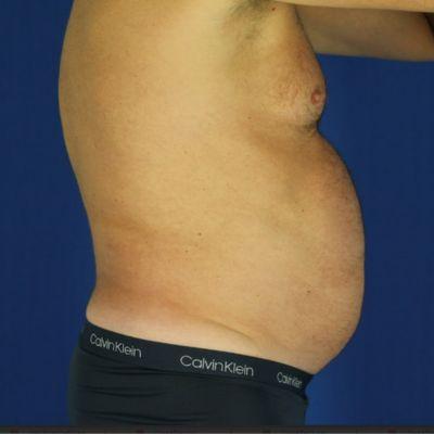 Liposuction before at EvolvMD MedSpa & Wellness I Milwaukee, WI in Wauwatosa, WI