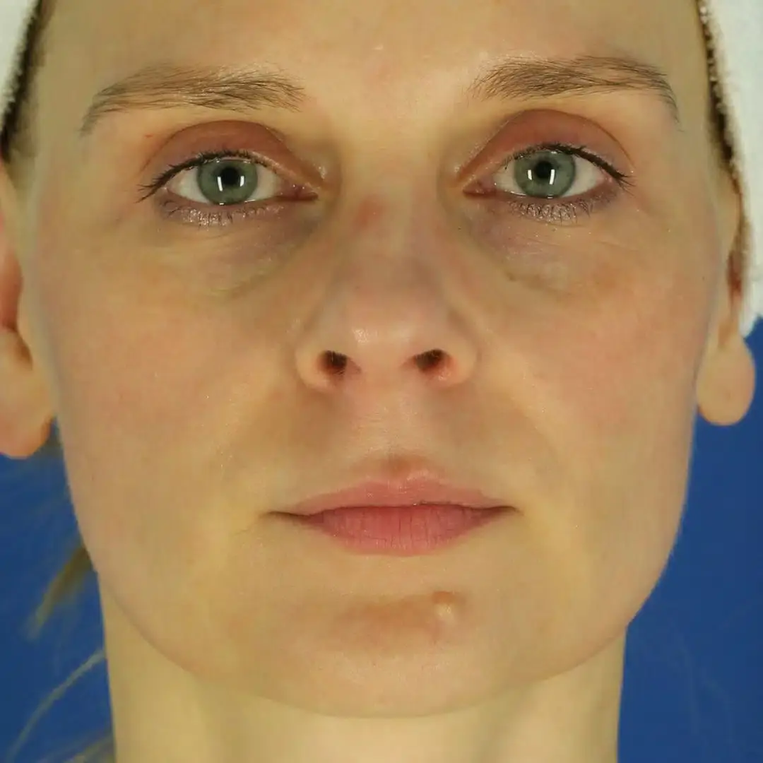 EvolvMD MedSpa & Wellness I Milwaukee, WI microneedling after — Wauwatosa, WI