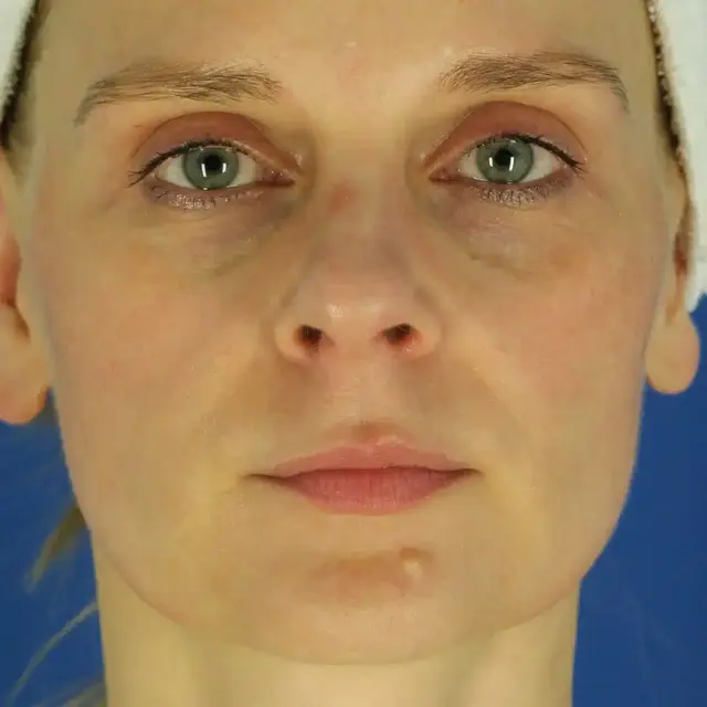 Microneedling after at EvolvMD MedSpa & Wellness I Milwaukee, WI in Wauwatosa, WI