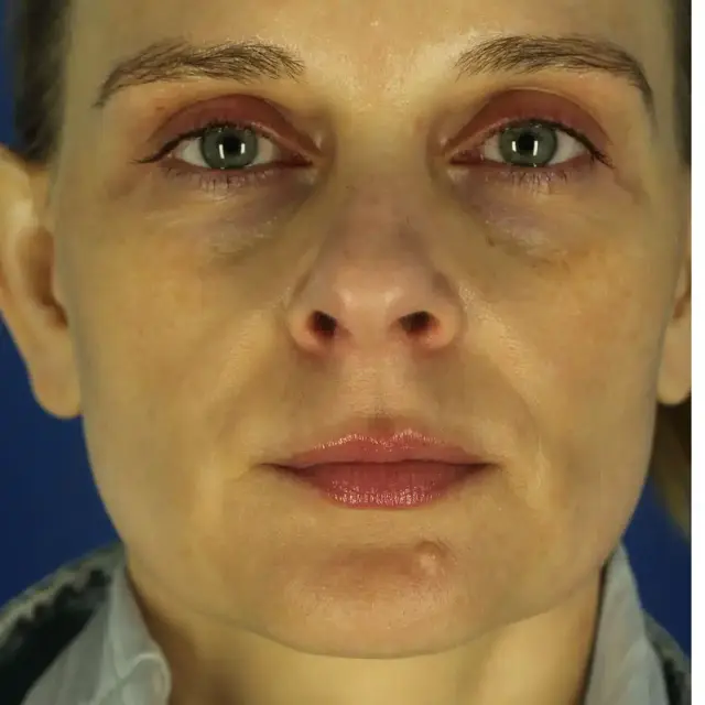 Microneedling before at EvolvMD MedSpa & Wellness I Milwaukee, WI in Wauwatosa, WI