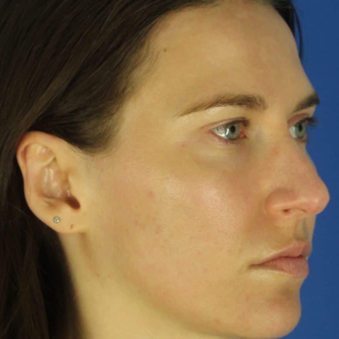EvolvMD MedSpa & Wellness I Milwaukee, WI microneedling after — Wauwatosa, WI