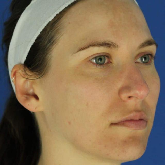 Morpheus8 before at EvolvMD MedSpa & Wellness I Milwaukee, WI in Wauwatosa, WI