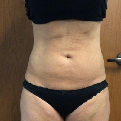 Liposuction after at EvolvMD MedSpa & Wellness I Milwaukee, WI in Wauwatosa, WI