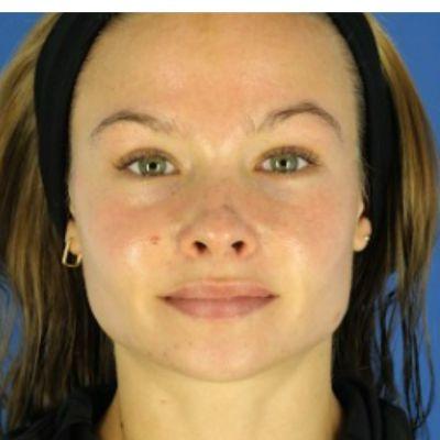 EvolvMD MedSpa & Wellness I Milwaukee, WI laser treatment after — Wauwatosa, WI